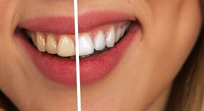 Why do I need teeth whitening if I brush them every day?