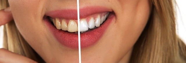 Why do I need teeth whitening if I brush them every day?