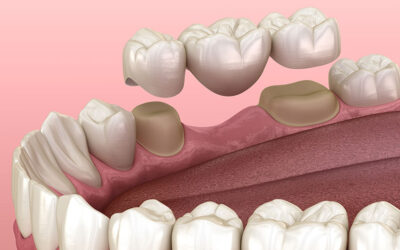 What is the difference between a bridge or a crown?