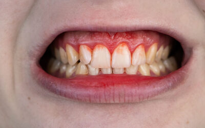 6 Dangers of Untreated Gum Disease in The Woodlands, TX