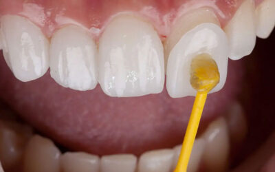 What Are the Main Differences Between Lumineers and Veneers?