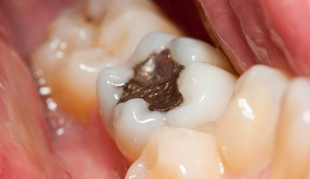 Dental Fillings: Options and Benefits