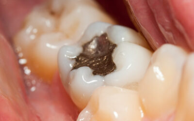 Dental Fillings: Options and Benefits