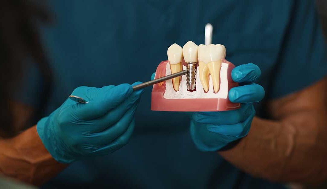 Dental Implants