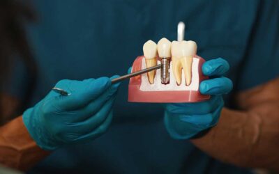Missing a Tooth? What Can Happen If You Delay Replacement