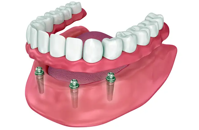 Dentures