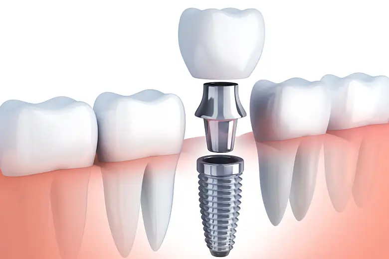 Implant Procedure
