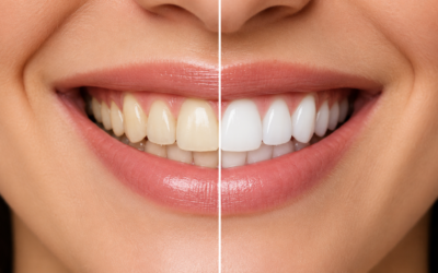 Why Do Teeth Stain? The Truth Behind Discoloration