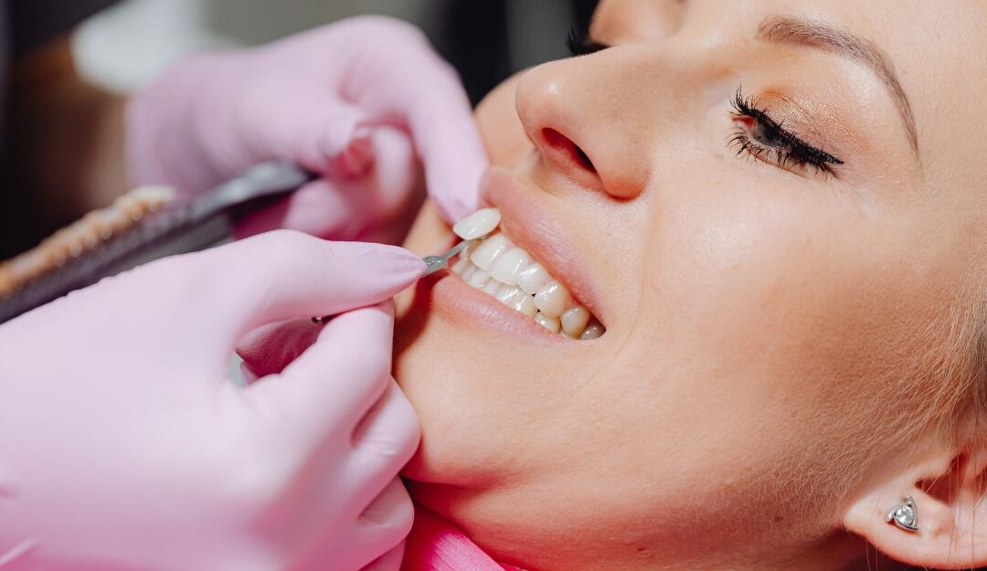 Veneers